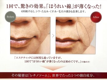 エルム/究極のエイジングフェイシャル★