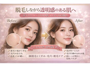 キャンディ 海老名駅前店(Candy)/顔脱毛(最新アレイズライト)