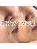 【毛穴・たるみ毛穴改善】隠すメイク卒業★ハーブピーリング＋VC導入