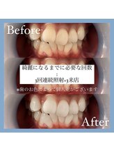 ホワイトニングカフェ 千葉店/Before/After