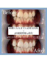 ホワイトニングカフェ 千葉店/Before/After