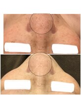 ブローチ 岡崎店(BROOCH)/驚きの効果！毛穴ピーリング