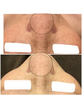 ブローチ 岡崎店(BROOCH)/驚きの効果!毛穴ピーリング