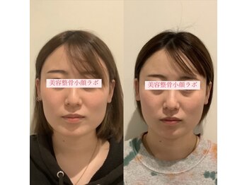 美容整骨小顔ラボ/小顔矯正ビフォーアフター