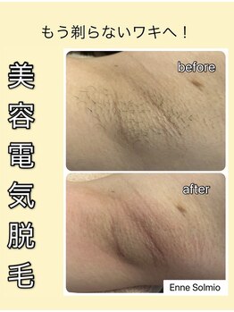 エンネソルミオ(Enne Solmio)/美容電気脱毛♪