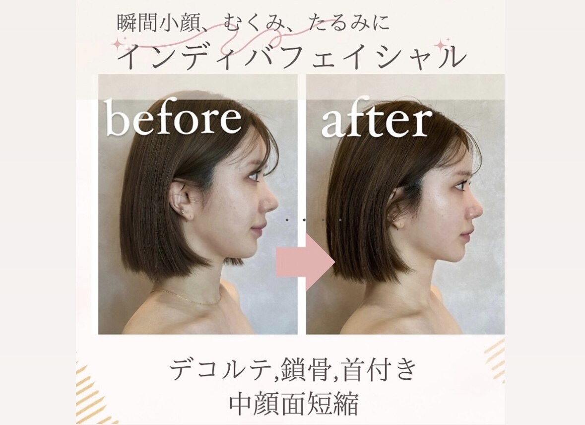 インディバ 頭皮に関するサロン インディバ痩身・小顔・美肌脱毛
