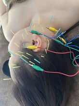 瑞 鍼灸院/頭皮鍼+美容鍼