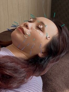 鍼灸施術を受けたい