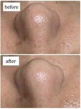 ユズドット(yuzu.)/黒ずみ毛穴に特におすすめ