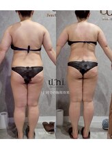 ユニ(uni.)/痩身症例