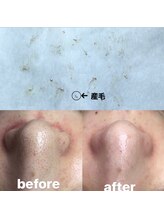 ビューティーネイル(Beauty Nail)/毛穴エクストラクション