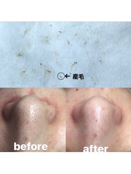 ビューティーネイル(Beauty Nail)/毛穴エクストラクション