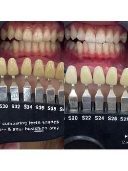 トウキョウスワーズ 池袋店(TOKYO SWRS)/#ホワイトニング #池袋 #渋谷