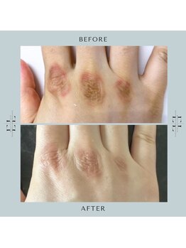 ラプティット(La petite)/【医師監修】話題のエクソリフト