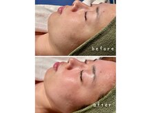 ラヴィアンローズ 各務原店(La vie en Rose)/フェイスラインもスッキリ