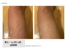 ルル(LULU.)/メンズ脱毛/足