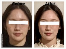 ショウフェイスデザイン(Sho Face Design)/《小顔矯正》ビフォーアフター