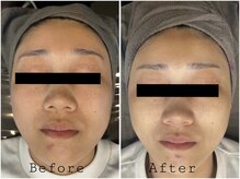 レイズ(RAISE)/乾燥・美肌ケア　光フェイシャル