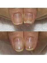 セラキュアネイル(Theracure nail)/爪剥離の緩和