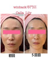 カラーリリー(Calla Lily)/左右差のお悩み（5回目）