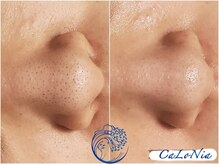 カロニア(CaLoNia)/毛穴の黒ずみ・開き