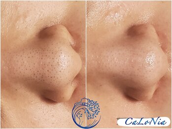 カロニア(CaLoNia)/毛穴の黒ずみ・開き