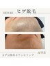 【メンズヒゲ脱毛】お試し体験