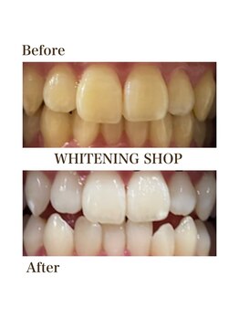 ホワイトニングショップ 岩出店(WHITENINGSHOP)/フリーパスBefore/After