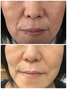 リズ(Liz)/ホームケアーのピュールボーテ