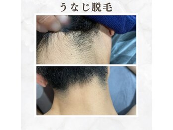 ボゴス 天白店(BOGOSS)/【うなじ脱毛】施術写真