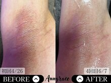アングレイス(Anngrace)/【全身脱毛ワキ】Before/After