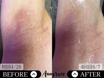 アングレイス(Anngrace)/【全身脱毛ワキ】Before/After