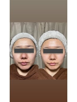 リラチル(relachill)/グローパック【炭酸ガスパック】