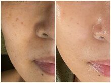 ルミエール フォレストサイド(L’MIERE forestside)/気になる頬のシミ改善始めよう！