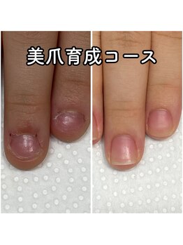 チェンジ(CHANGE)/かみ癖、深爪の悩み