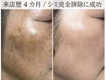 ラグランシエル(Le grand ciel)/劇的beforeAfter