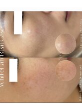 ルミラポー(Lumira Peau)/シミ集中ケア