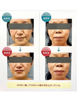エルム/たるみむくみに深層リフトアップ