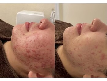 エト(eto.)/赤ニキビ