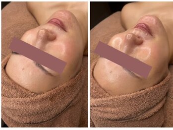 モクレンの写真/韓国開発の「ララピール」でシミしわを改善し水光ツヤ肌とハリのある素肌へ導く♪