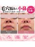 【2回目～/参考価格】超音波毛穴洗浄＋小鼻リフト◆引き締まった美鼻へ ♪