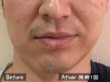 ココモンド(COCOMONDO)/顔脱毛/ヒゲ脱毛/メンズ脱毛