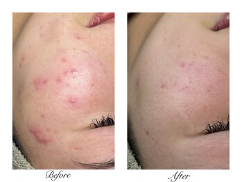 シルビー(CILBE)/ハーブトリートメント