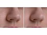 【小鼻徹底ケア★黒ずみ/皮脂】米wax小鼻ケア＋EMS角栓除去＋LED光フォト導入