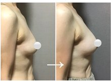 Ms.やまとなでしこ 明石店/バストアップビフォーアフター3