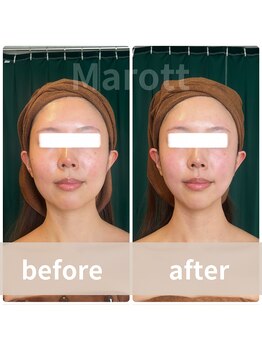 マロット 表参道店(Marott)/【30代女性】小顔たるみ改善♪