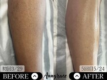 アングレイス(Anngrace)/【全身脱毛脚】Before/After