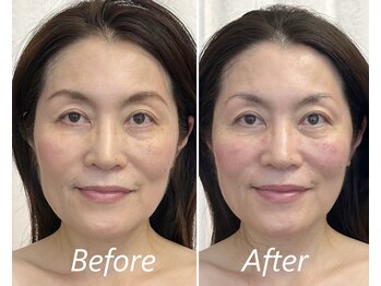 ドクターボディ 新宿店(Dr.Body)/【輪郭の凹凸/面長/小顔 50代】