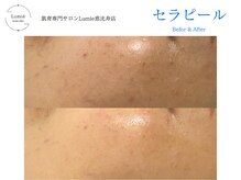ルミエ 恵比寿店(Lumie)/【韓国式肌管理】セラピール症例
