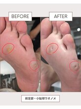 リットフット(LitFoot)/前足部・小趾球の魚の目